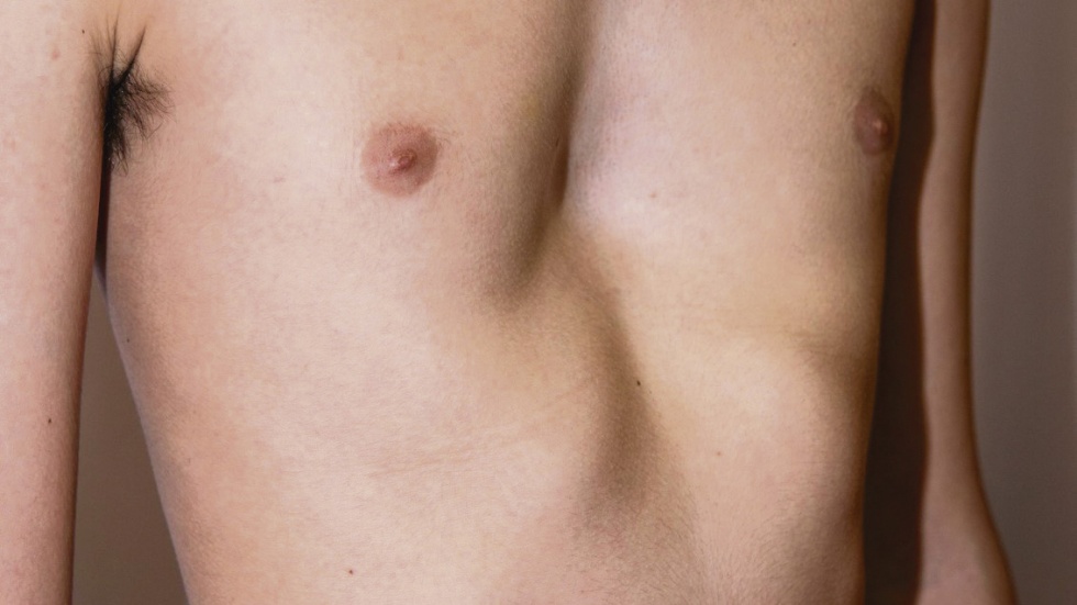 El pectus excavatum es una deformidad congénita de la caja torácica.