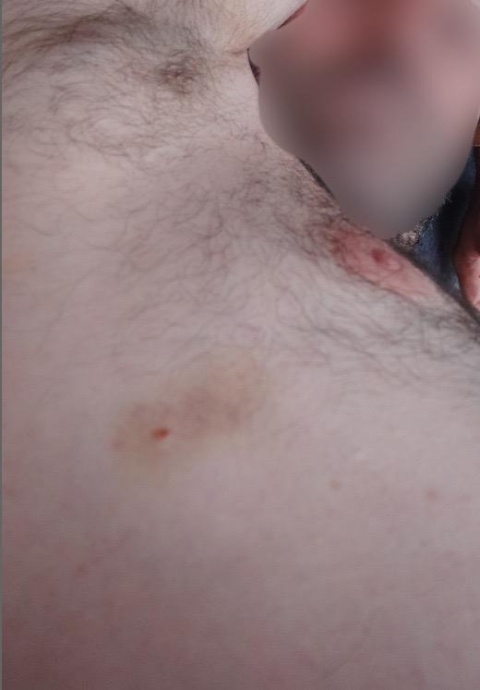 Estado de las lesiones a 11 de agosto, nueve días después de los hechos.